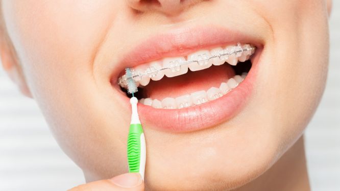 Persona usando un cepillo interdental para limpiar entre los brackets y los alambres, ilustrando una técnica eficaz de higiene bucal durante el tratamiento de ortodoncia.