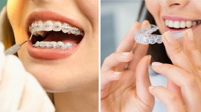 brackets vs invisalign