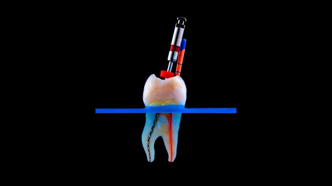 Endodoncia