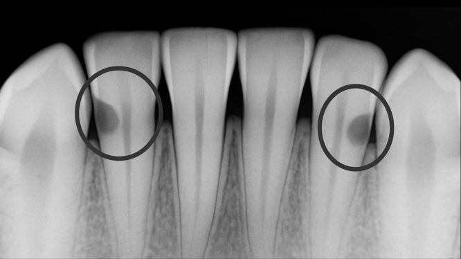 Caries interproximal: la caries que no se ve