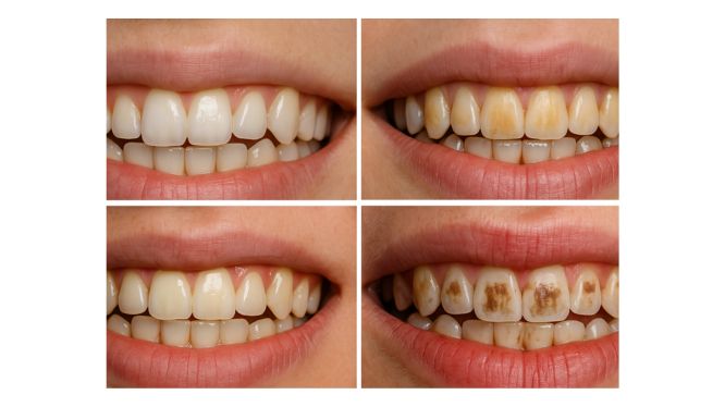 ¿Qué es la fluorosis dental? Causas, síntomas, tratamientos y cómo recuperar una sonrisa perfecta