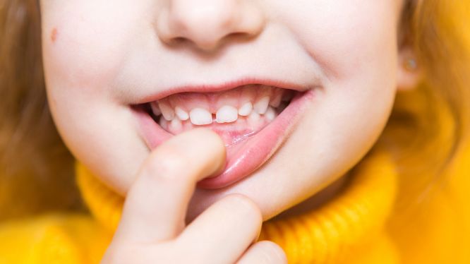 Mordida profunda: qué es, por qué se produce y cómo la ortodoncia moderna la corrige de forma segura y controlada 