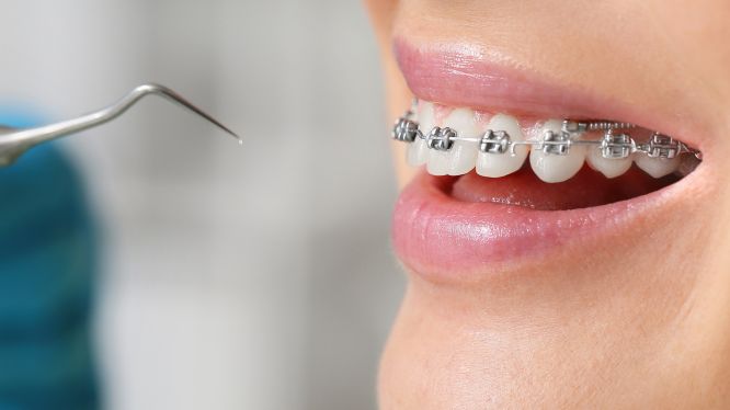 Retratamiento de ortodoncia: por qué algunos pacientes necesitan una segunda fase