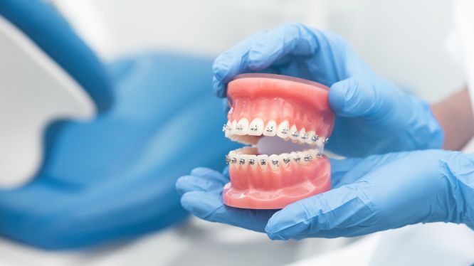 Retratamiento de ortodoncia: por qué algunos pacientes necesitan una segunda fase