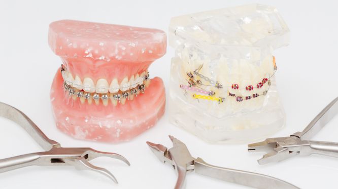 Retratamiento de ortodoncia: por qué algunos pacientes necesitan una segunda fase