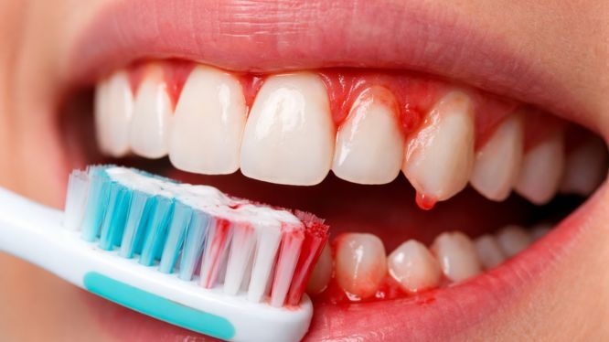 ¿Por qué me sangran las encías aunque me cepille todos los días?