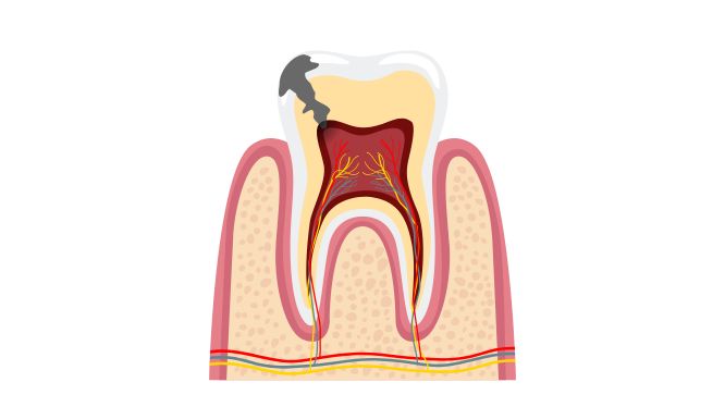 Latidos o pulsaciones en una muela: ¿es infección?