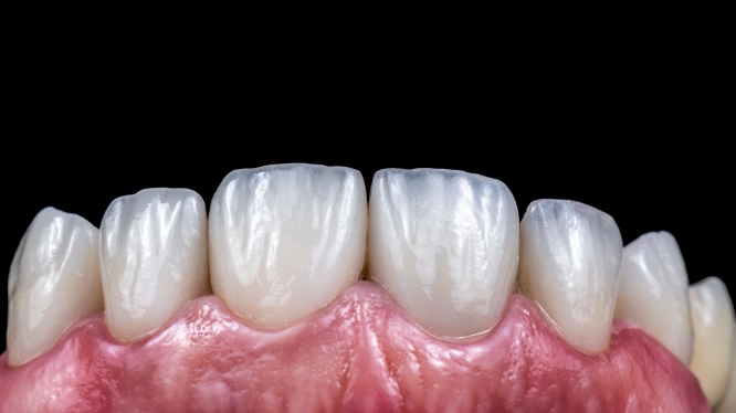 Diseño de sonrisa: qué es, en qué consiste y quién lo necesita