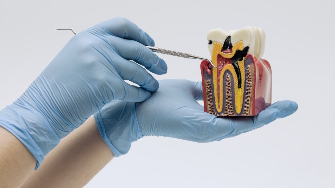 ¿Qué es una endodoncia? La guía definitiva para salvar tu sonrisa (y evitar perder tu diente)