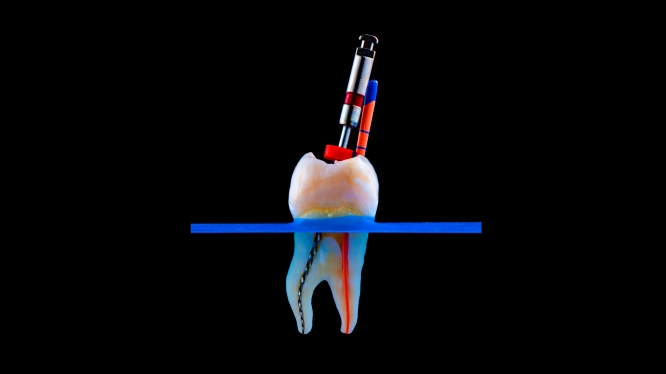 ¿Qué es una endodoncia? La guía definitiva para salvar tu sonrisa (y evitar perder tu diente)