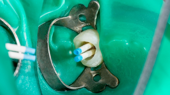 ¿Qué es una endodoncia? La guía definitiva para salvar tu sonrisa (y evitar perder tu diente)