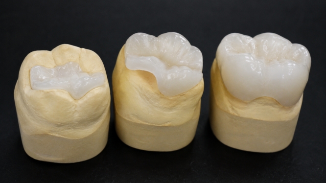 ¿Qué es una incrustación dental y cuándo se necesita?