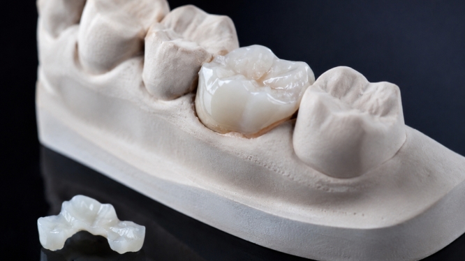 ¿Qué es una incrustación dental y cuándo se necesita?