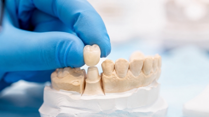 ¿Qué es una corona dental y cuándo se necesita? La solución que puede salvar tu sonrisa