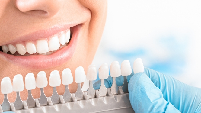 Blanqueamiento dental en Querétaro: cuánto cuesta, cuánto dura y qué diferencia hay con hacerlo en casa