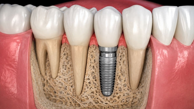 Implantes dentales en Querétaro: quién puede colocárselos, cómo es el procedimiento y cuánto cuestan